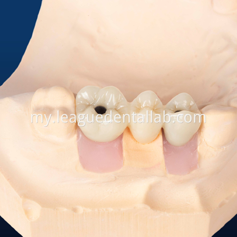 Dental Implant Crown, Dental Implant Zirconia crown,Dental Implant Emax crown,Dental Implant Bridge